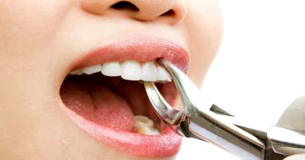 تفسير حلم خلع الأسنان والضروس بالتفصيل معلومة ثقافية