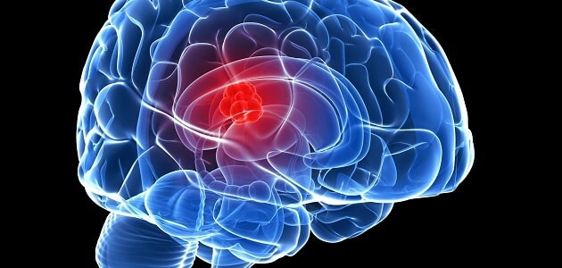 هل نزيف الدماغ يسبب الوفاة وما مدى الشفاء منه معلومة ثقافية