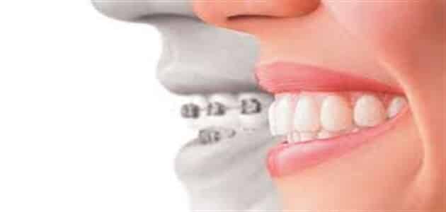 طريقة إزالة تقويم الأسنان في البيت معلومة ثقافية