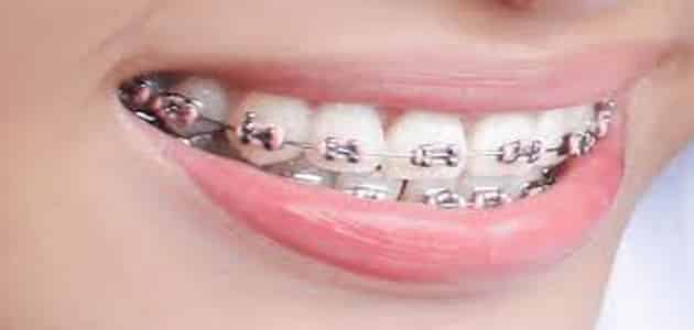 تقويم الاسنان مميزاته وعيوبه معلومات هامة معلومة ثقافية