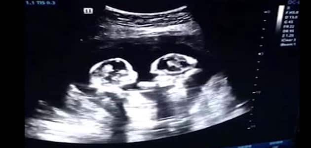 سونار الحمل بتوأم في الشهر الاول mariubuyana